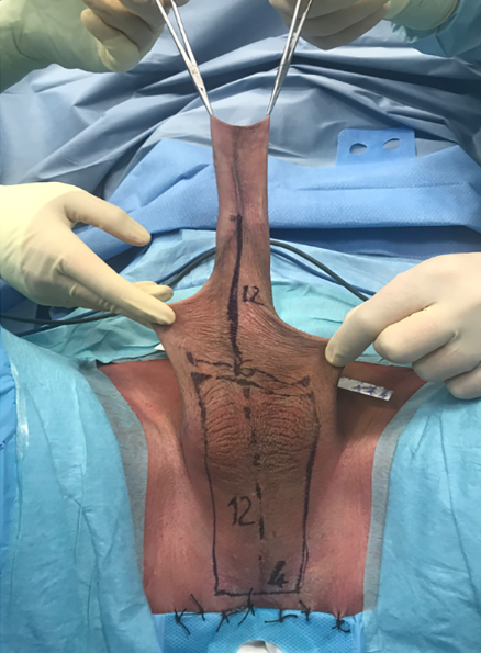 An intraoperative photograph showing a surgical flap template drawn in ink on a patient&rsquo;s skin within a blue sterile drape, the tissue held up by forceps. A long vertical midline is labeled &lsquo;12,&rsquo; and a lower, tapered rectangular outline is marked &lsquo;12&rsquo; and &lsquo;4&rsquo; &mdash; the planned length and width, in centimeters, of the tissue flap that will be raised and tubed to build the neophallus and its urethra.